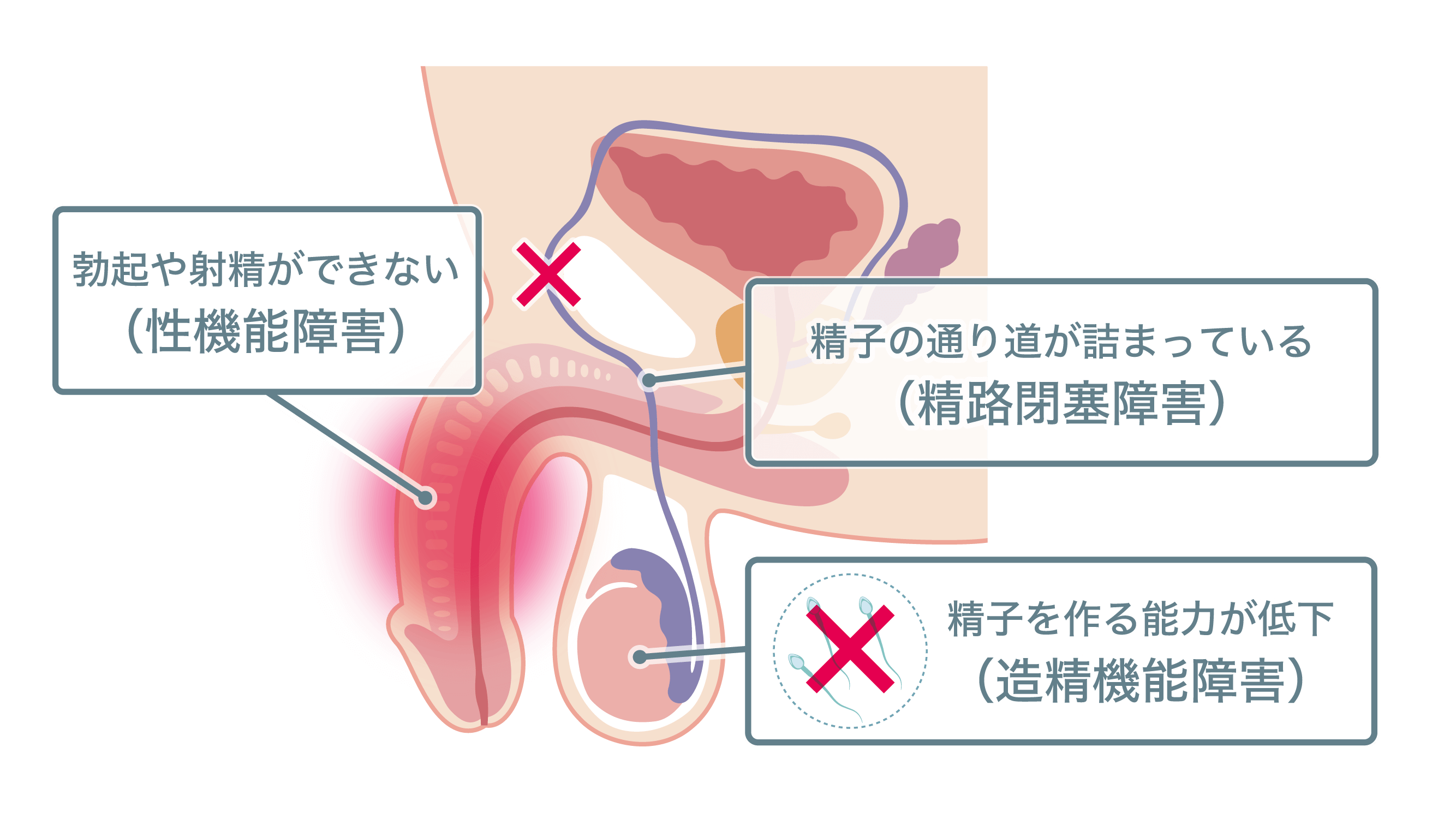 男性不妊症の原因