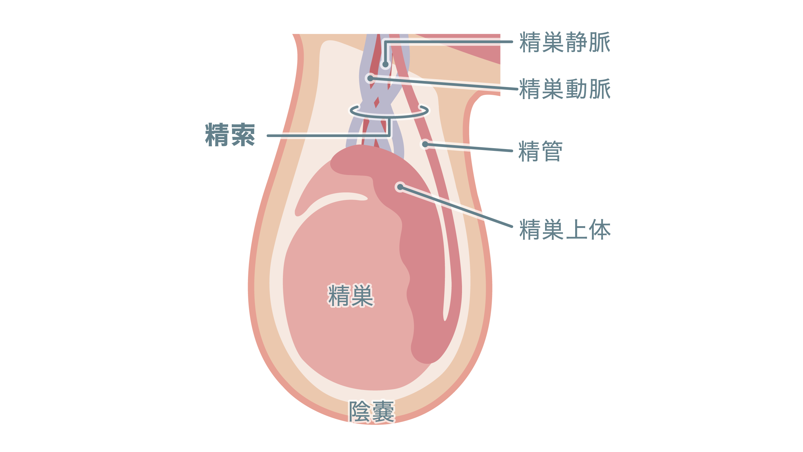 精索静脈瘤